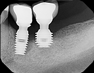Peri-implantitis with Bicon_07